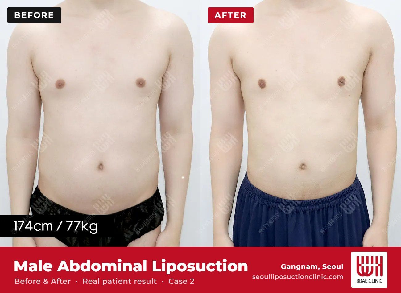 Male abdominal liposuction before and after, case 2 (photo 2 of 2) – BBAE Clinic, Gangnam Seoul