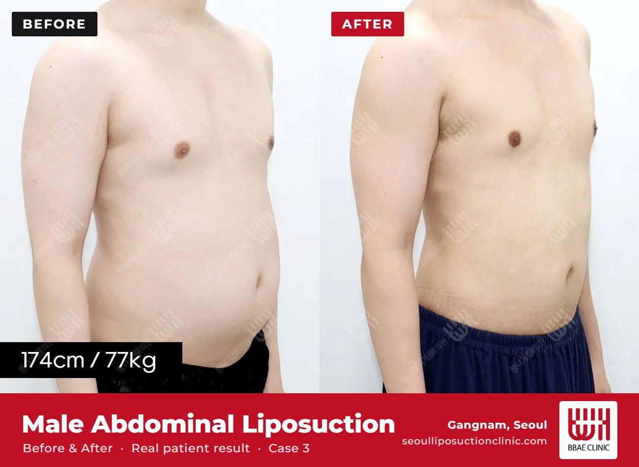 Male abdominal liposuction before and after, case 3 (photo 1 of 2) – BBAE Clinic, Gangnam Seoul