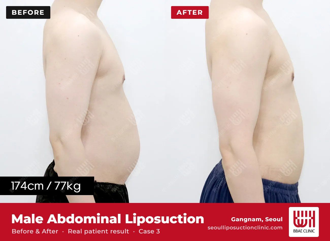 Male abdominal liposuction before and after, case 3 (photo 2 of 2) – BBAE Clinic, Gangnam Seoul