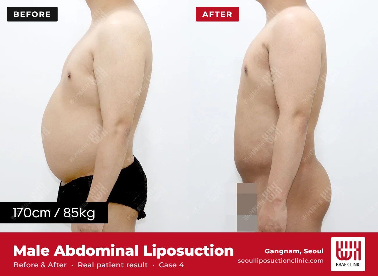 Male abdominal liposuction before and after, case 4 (photo 1 of 2) – BBAE Clinic, Gangnam Seoul