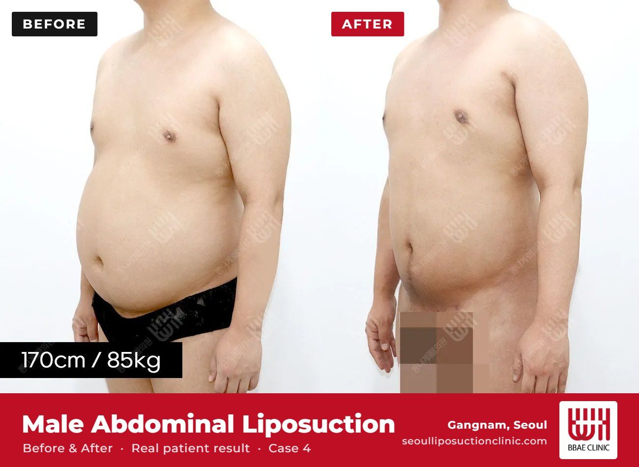 Male abdominal liposuction before and after, case 4 (photo 2 of 2) – BBAE Clinic, Gangnam Seoul
