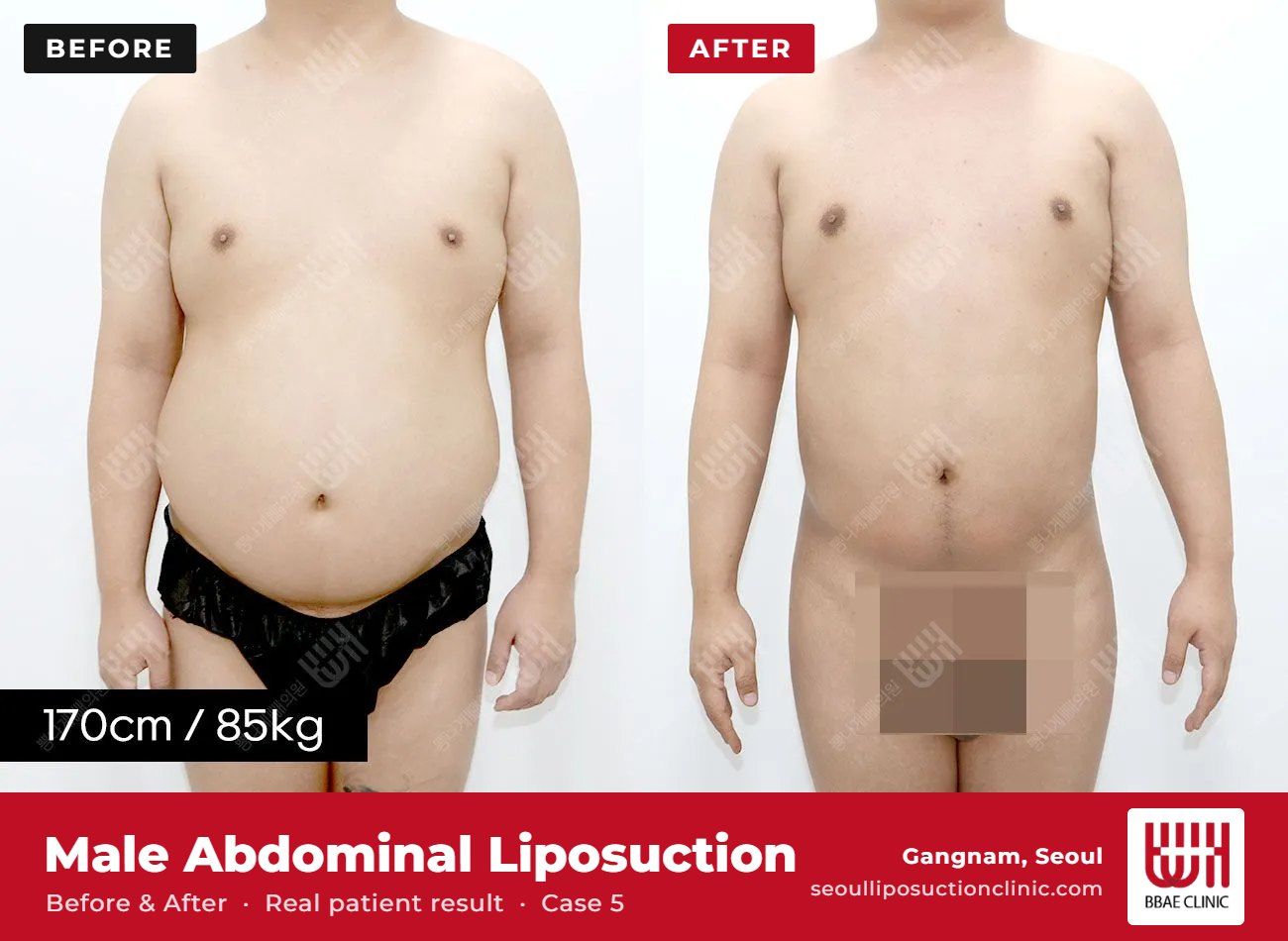 Male abdominal liposuction before and after, case 5 (photo 1 of 2) – BBAE Clinic, Gangnam Seoul