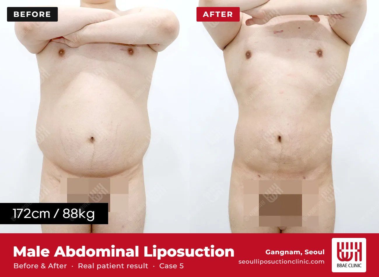 Male abdominal liposuction before and after, case 5 (photo 2 of 2) – BBAE Clinic, Gangnam Seoul