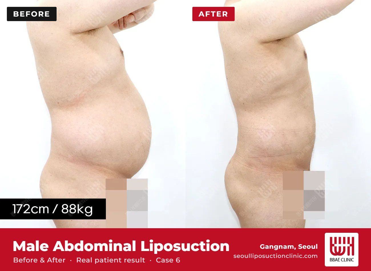 Male abdominal liposuction before and after, case 6 (photo 1 of 2) – BBAE Clinic, Gangnam Seoul