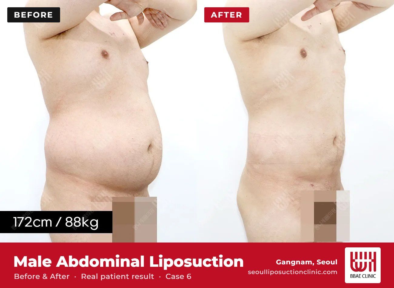Male abdominal liposuction before and after, case 6 (photo 2 of 2) – BBAE Clinic, Gangnam Seoul