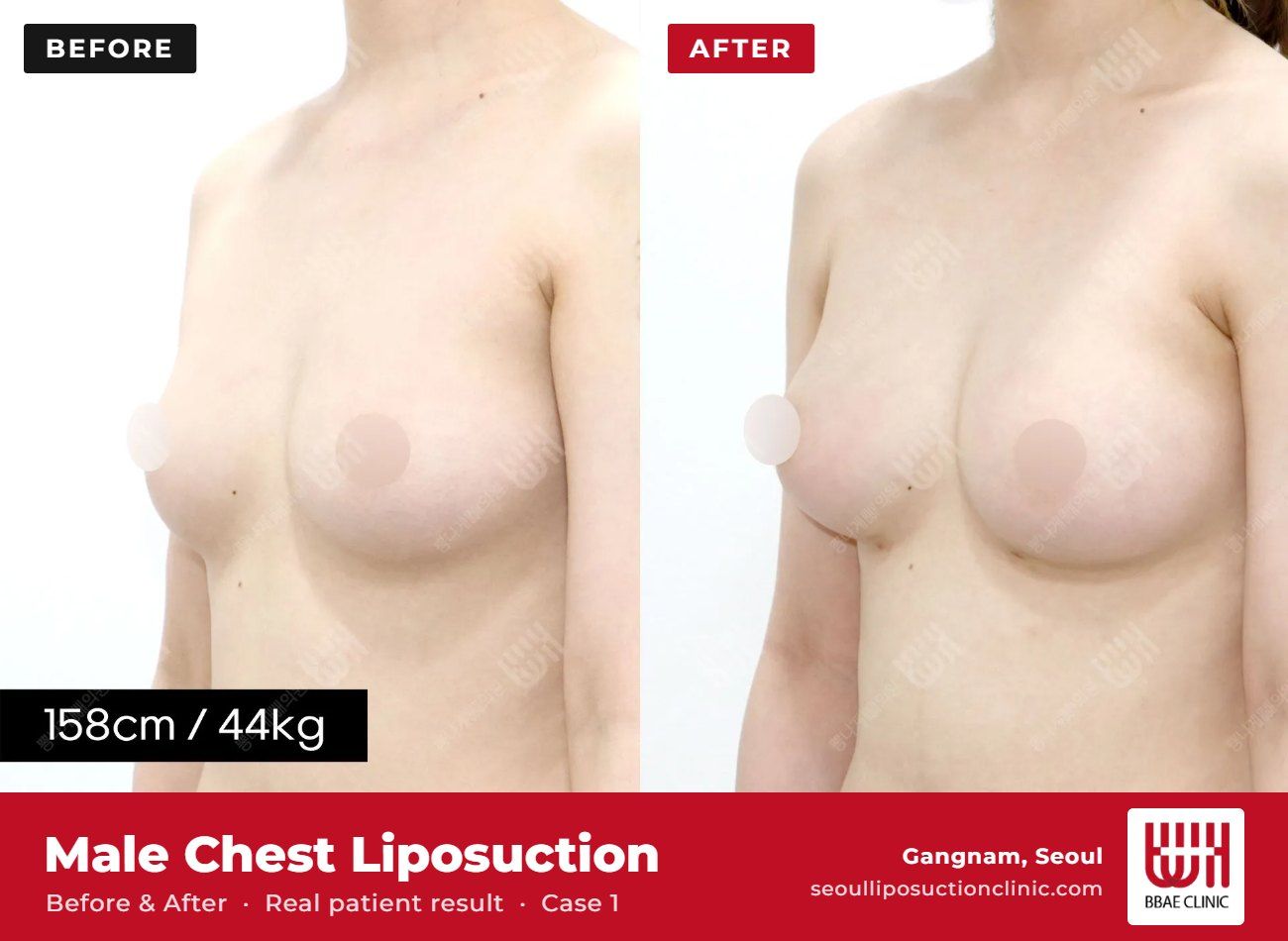 Male chest liposuction (gynecomastia) before and after, case 1 (photo 1 of 2) – BBAE Clinic, Gangnam Seoul