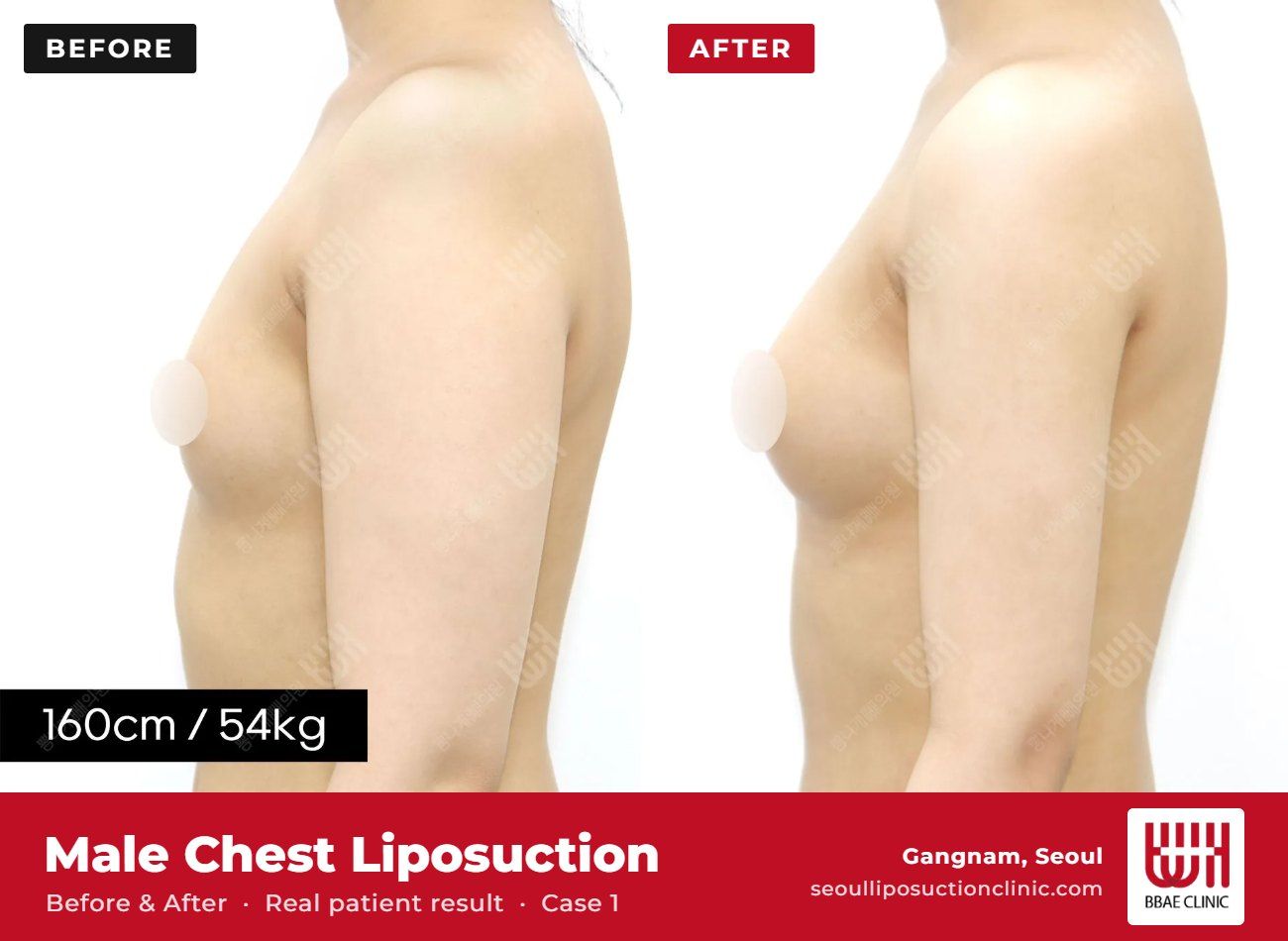 Male chest liposuction (gynecomastia) before and after, case 1 (photo 2 of 2) – BBAE Clinic, Gangnam Seoul