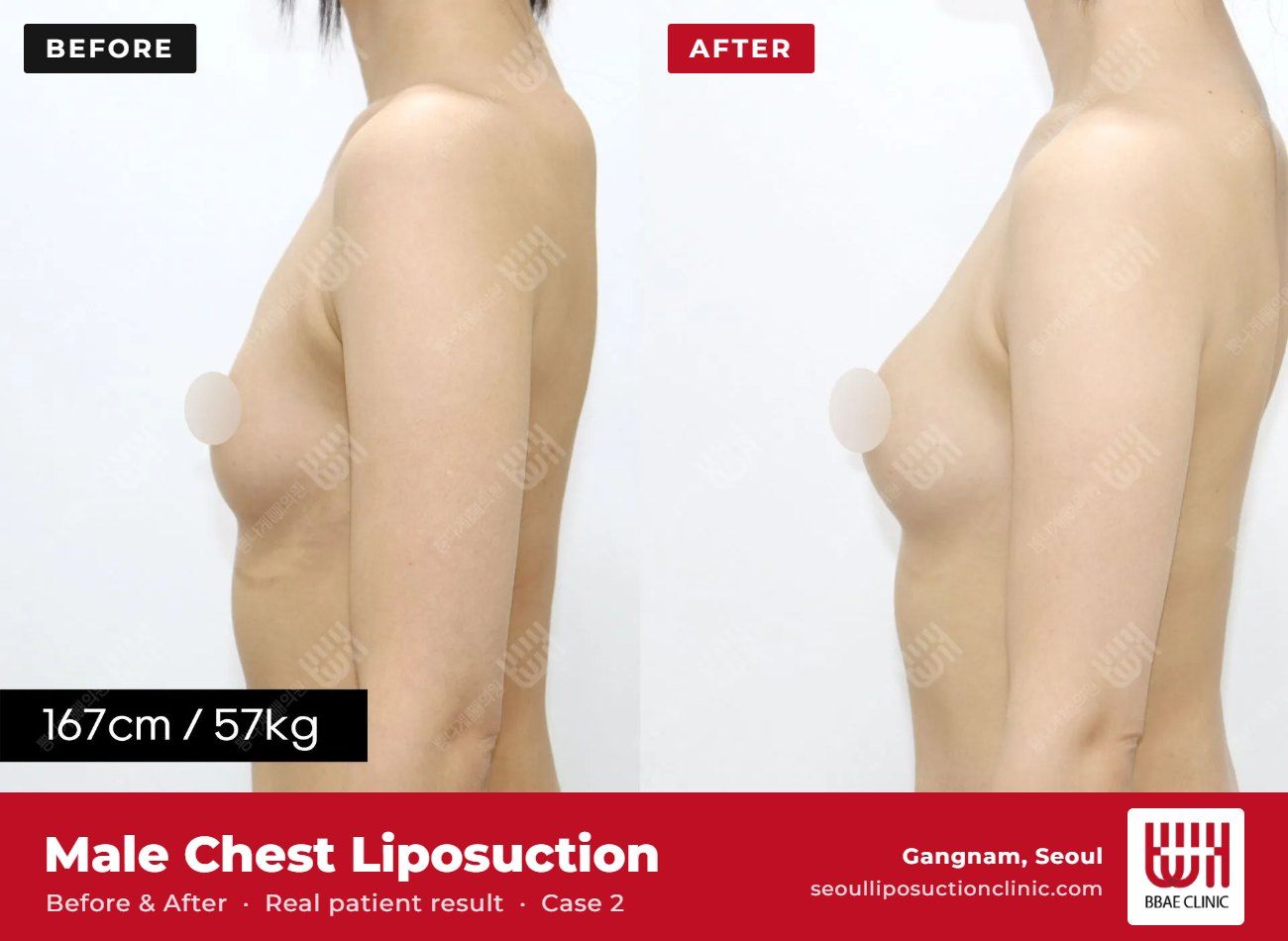 Male chest liposuction (gynecomastia) before and after, case 2 (photo 1 of 2) – BBAE Clinic, Gangnam Seoul