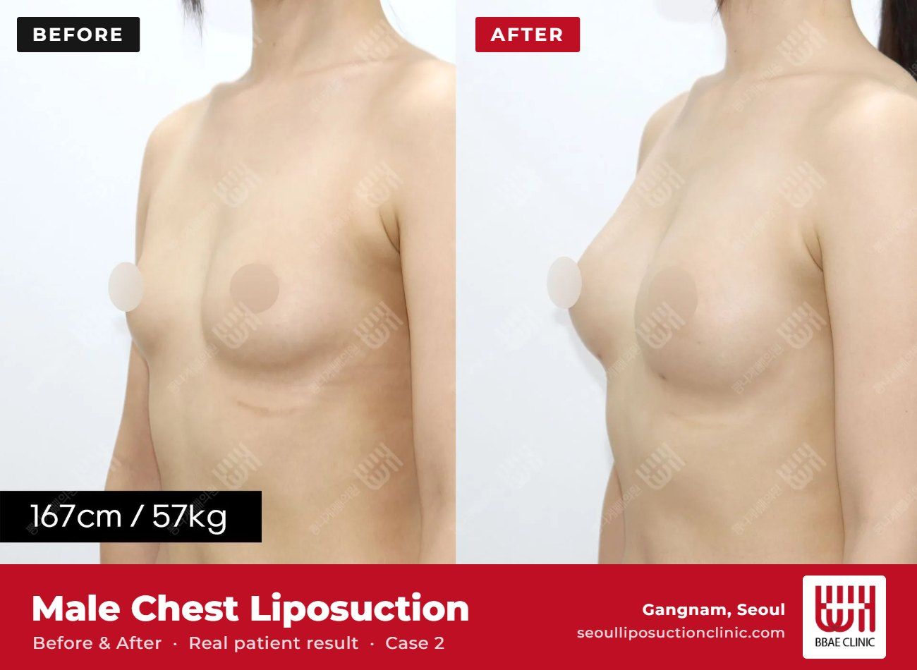 Male chest liposuction (gynecomastia) before and after, case 2 (photo 2 of 2) – BBAE Clinic, Gangnam Seoul