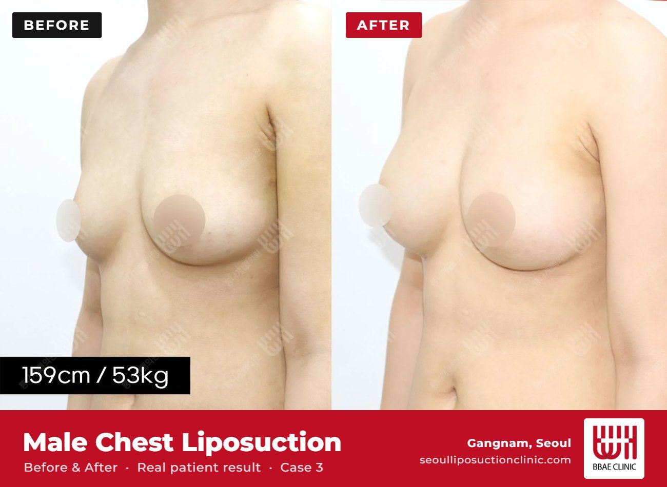 Male chest liposuction (gynecomastia) before and after, case 3 (photo 1 of 2) – BBAE Clinic, Gangnam Seoul