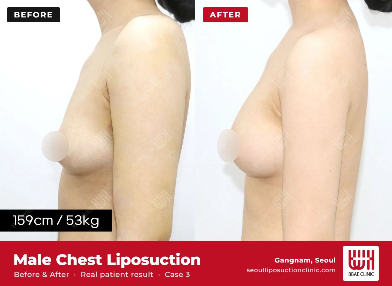 Male chest liposuction (gynecomastia) before and after, case 3 (photo 2 of 2) – BBAE Clinic, Gangnam Seoul