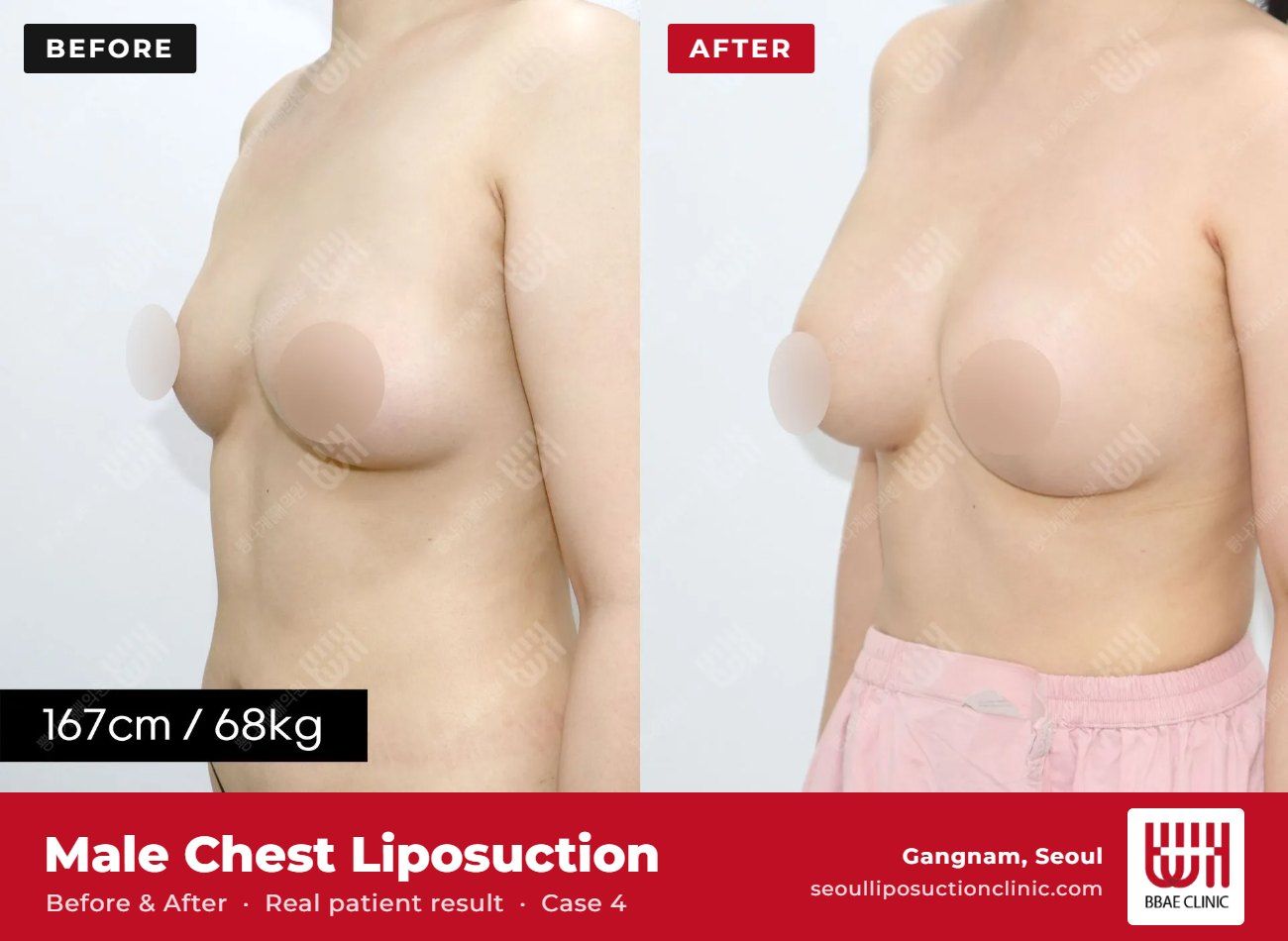 Male chest liposuction (gynecomastia) before and after, case 4 (photo 1 of 2) – BBAE Clinic, Gangnam Seoul