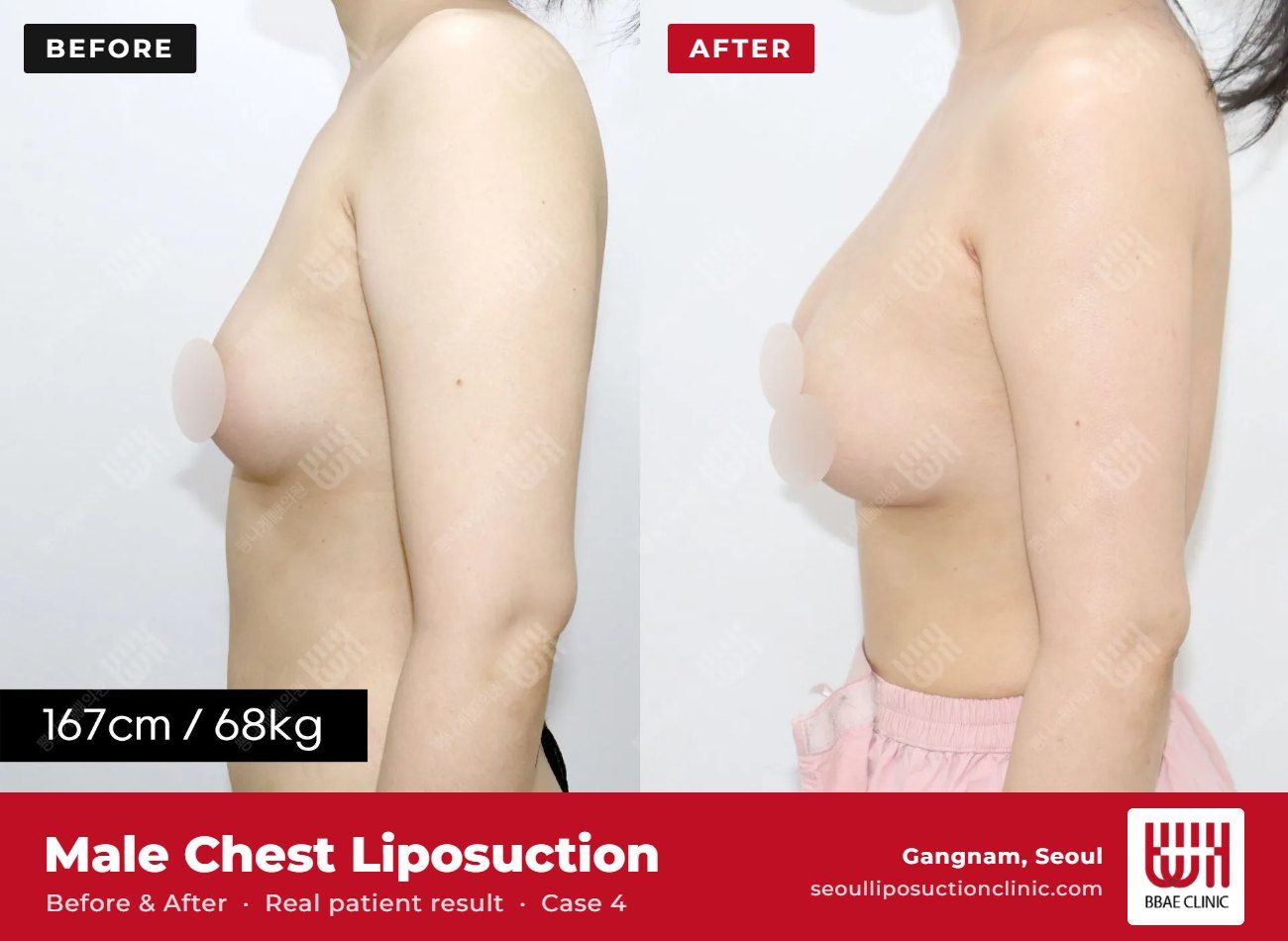 Male chest liposuction (gynecomastia) before and after, case 4 (photo 2 of 2) – BBAE Clinic, Gangnam Seoul
