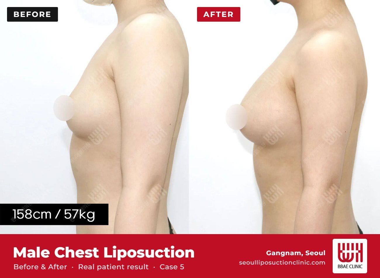 Male chest liposuction (gynecomastia) before and after, case 5 (photo 1 of 2) – BBAE Clinic, Gangnam Seoul