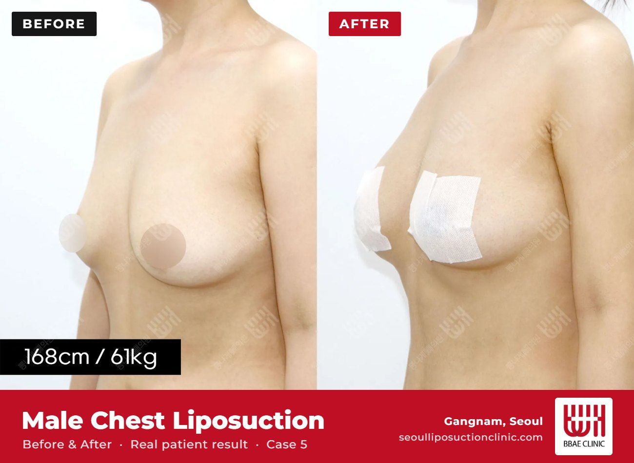 Male chest liposuction (gynecomastia) before and after, case 5 (photo 2 of 2) – BBAE Clinic, Gangnam Seoul