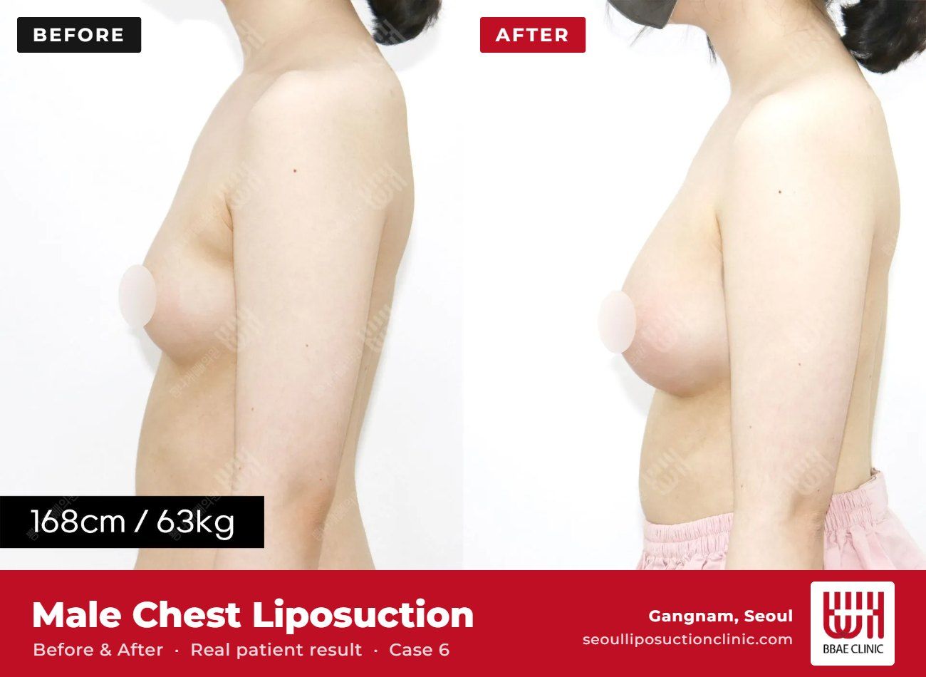 Male chest liposuction (gynecomastia) before and after, case 6 (photo 1 of 2) – BBAE Clinic, Gangnam Seoul