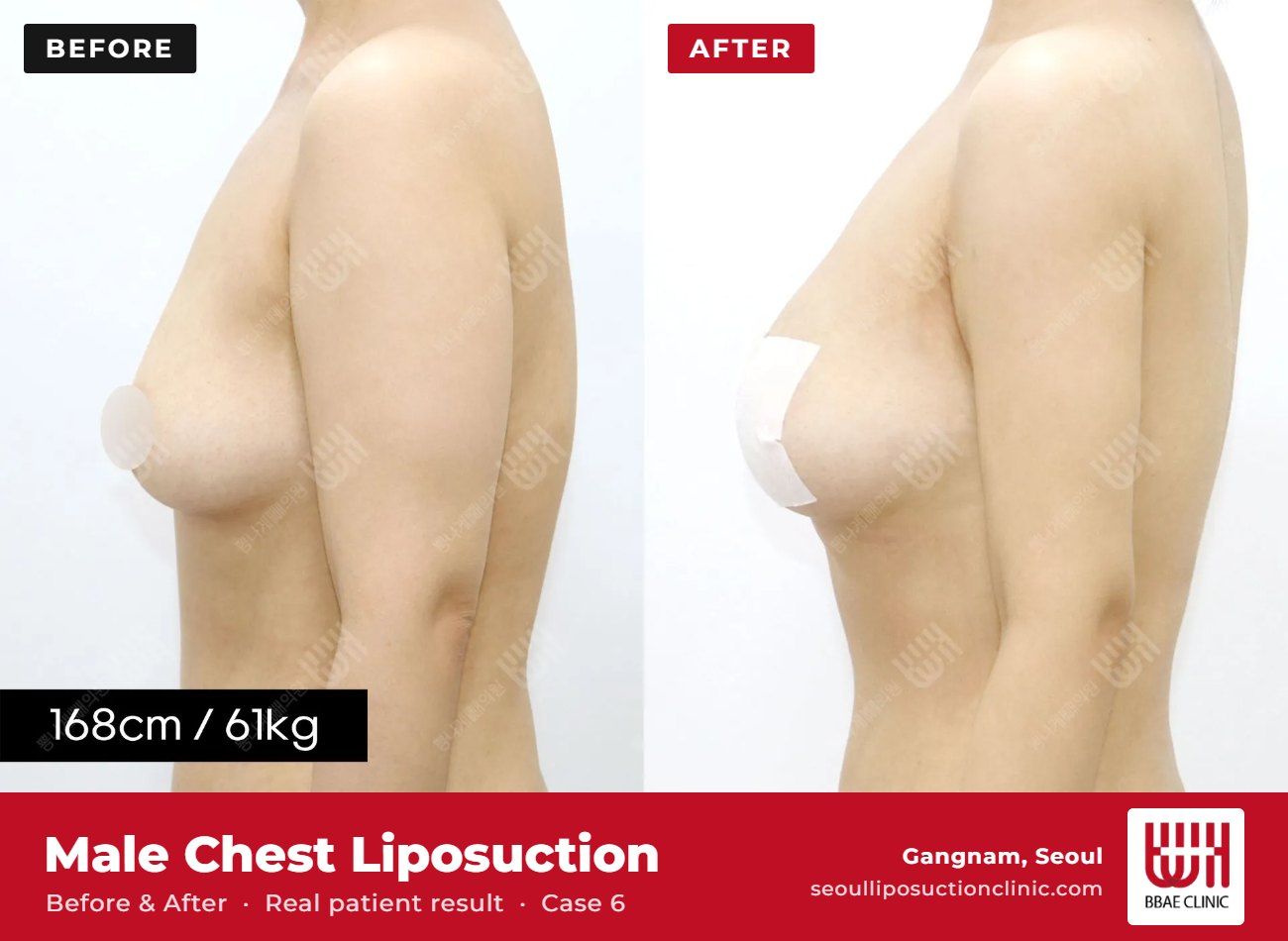 Male chest liposuction (gynecomastia) before and after, case 6 (photo 2 of 2) – BBAE Clinic, Gangnam Seoul