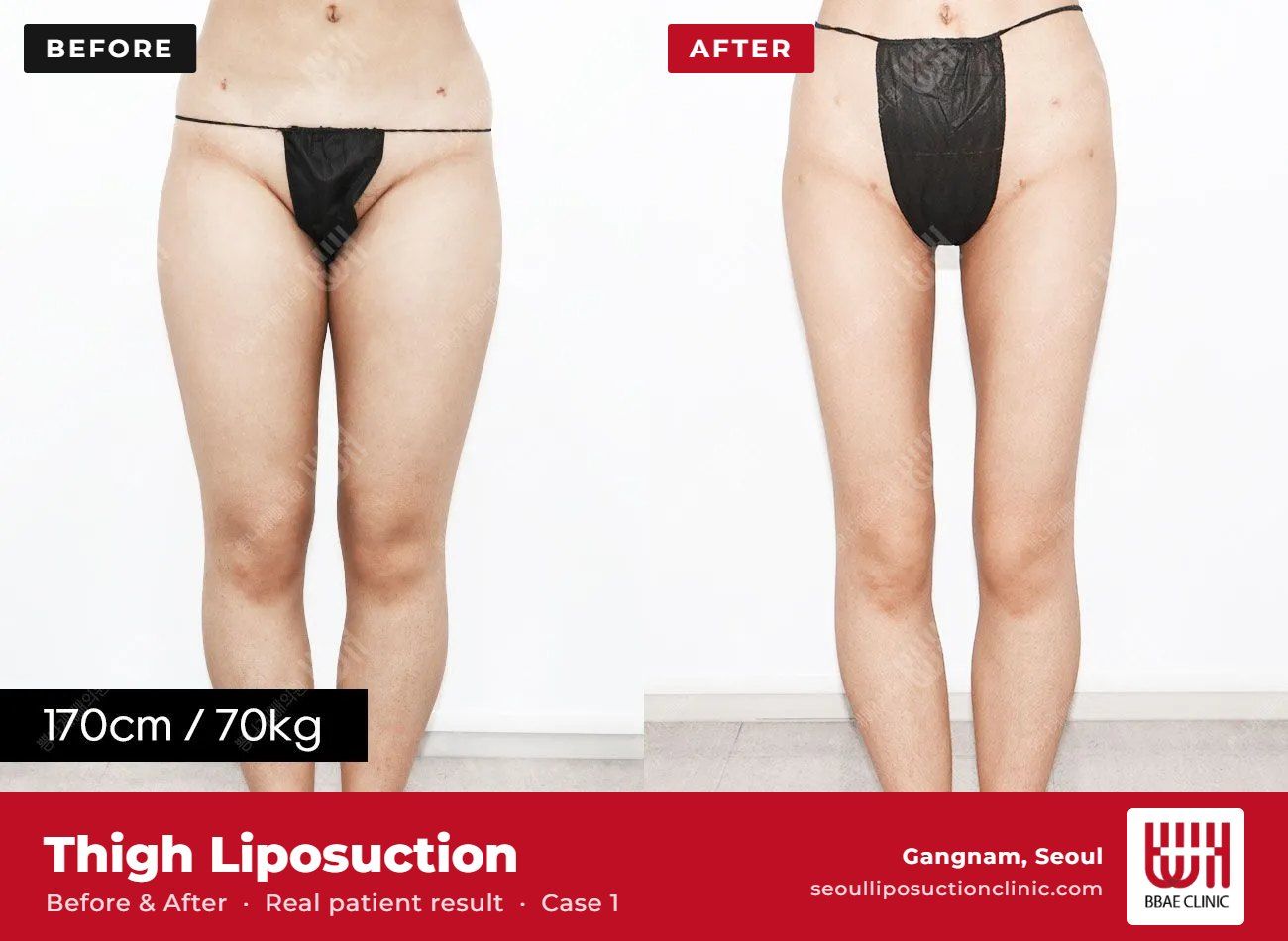 Thigh liposuction before and after, case 1 (photo 1 of 2) – BBAE Clinic, Gangnam Seoul