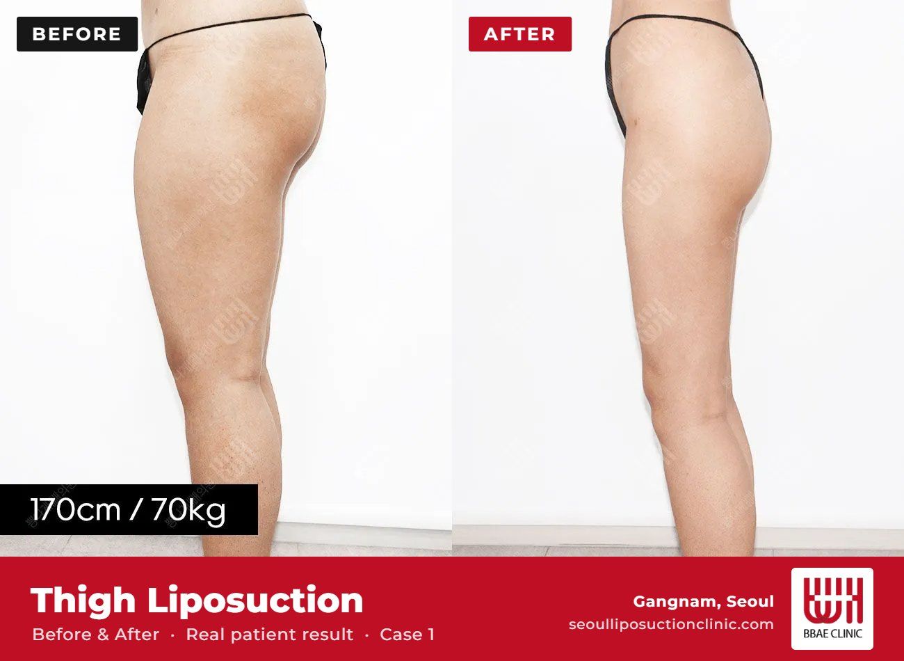 Thigh liposuction before and after, case 1 (photo 2 of 2) – BBAE Clinic, Gangnam Seoul