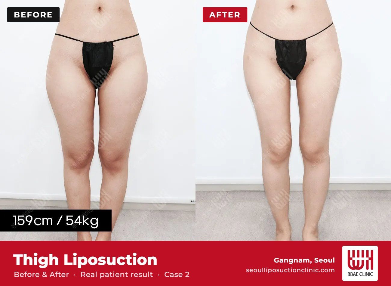 Thigh liposuction before and after, case 2 (photo 1 of 2) – BBAE Clinic, Gangnam Seoul