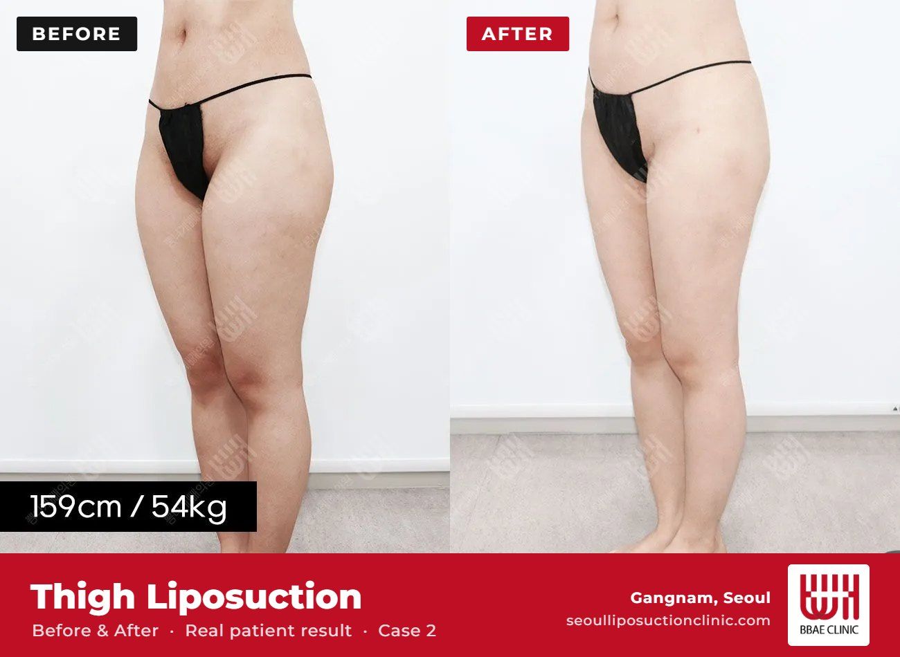 Thigh liposuction before and after, case 2 (photo 2 of 2) – BBAE Clinic, Gangnam Seoul