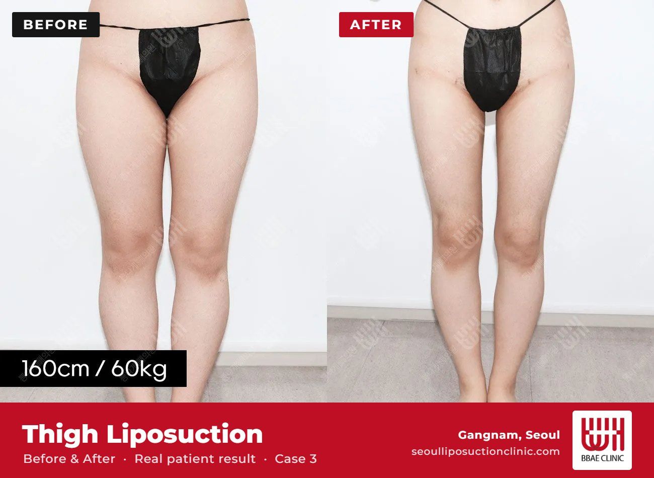 Thigh liposuction before and after, case 3 (photo 1 of 2) – BBAE Clinic, Gangnam Seoul