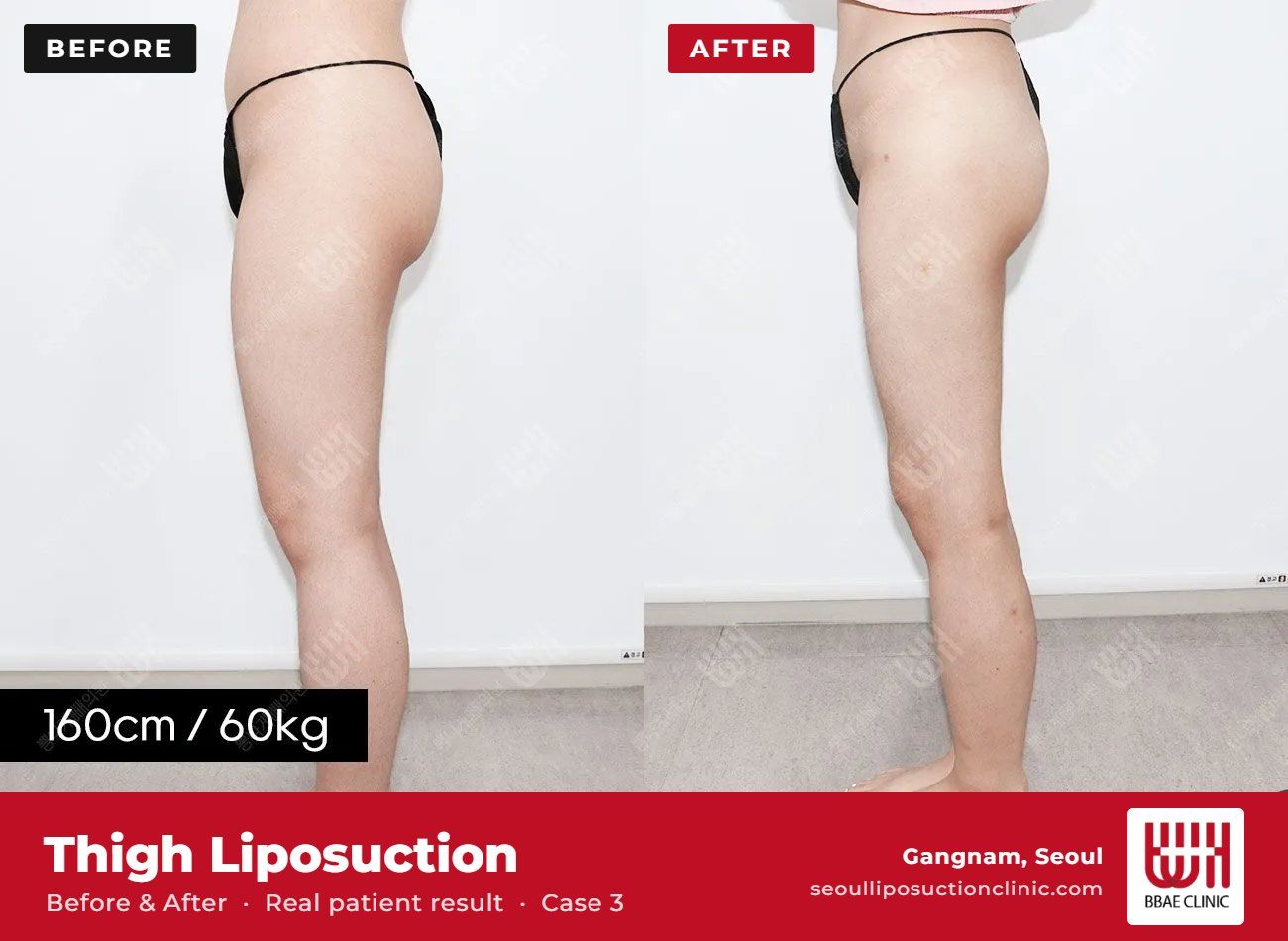 Thigh liposuction before and after, case 3 (photo 2 of 2) – BBAE Clinic, Gangnam Seoul