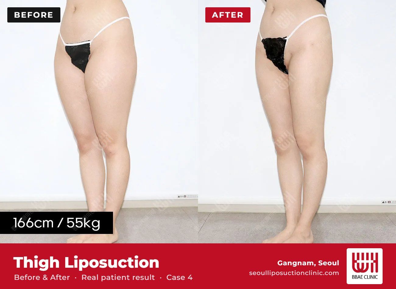 Thigh liposuction before and after, case 4 (photo 1 of 2) – BBAE Clinic, Gangnam Seoul