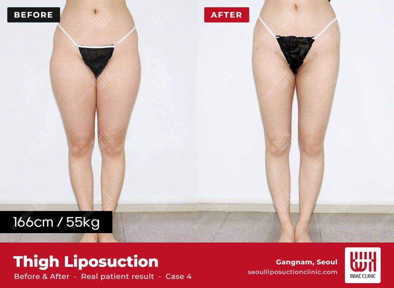 Thigh liposuction before and after, case 4 (photo 2 of 2) – BBAE Clinic, Gangnam Seoul