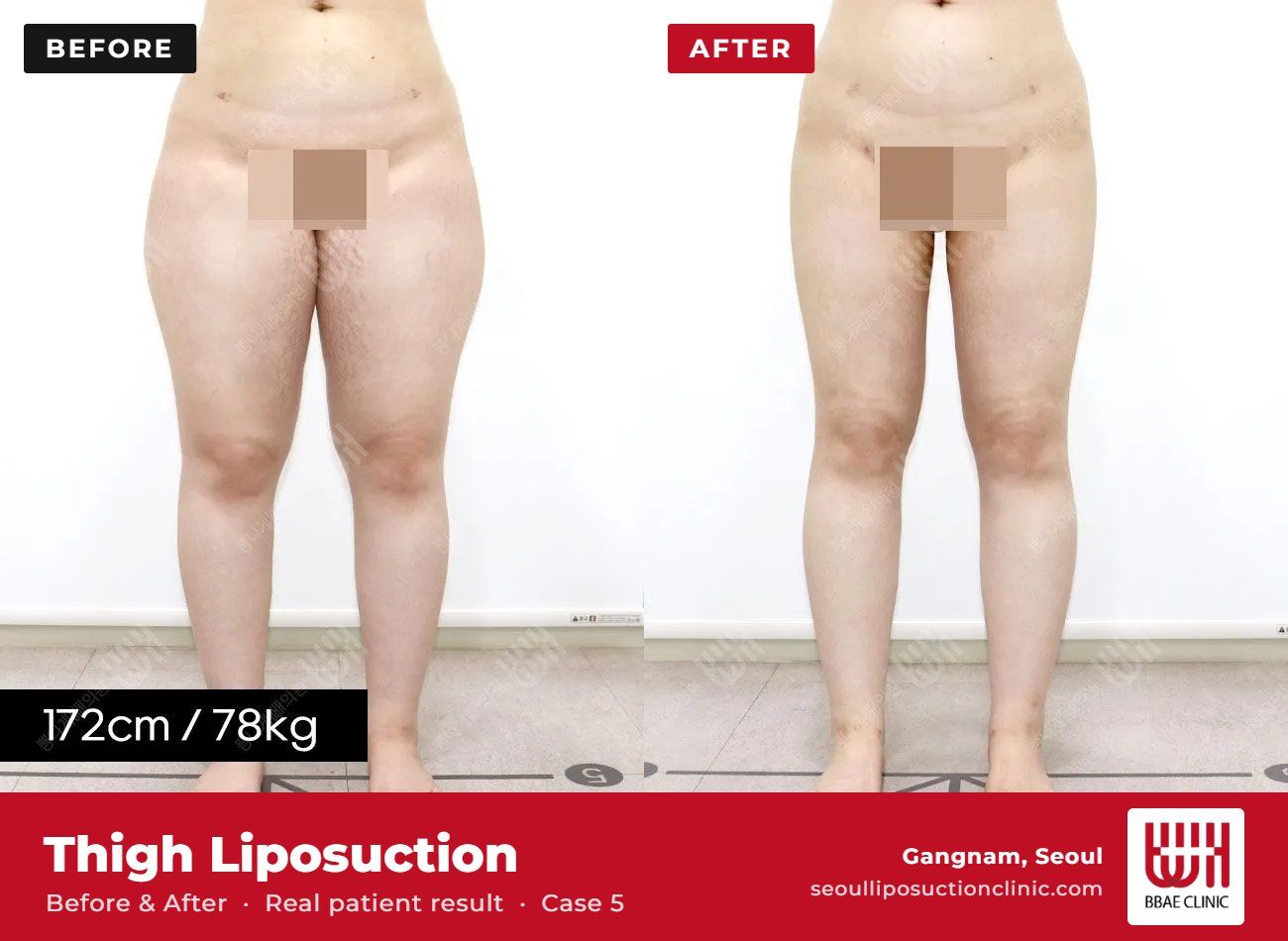 Thigh liposuction before and after, case 5 (photo 1 of 2) – BBAE Clinic, Gangnam Seoul