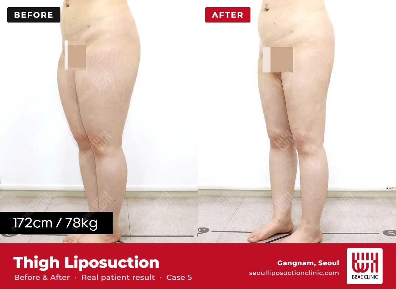 Thigh liposuction before and after, case 5 (photo 2 of 2) – BBAE Clinic, Gangnam Seoul