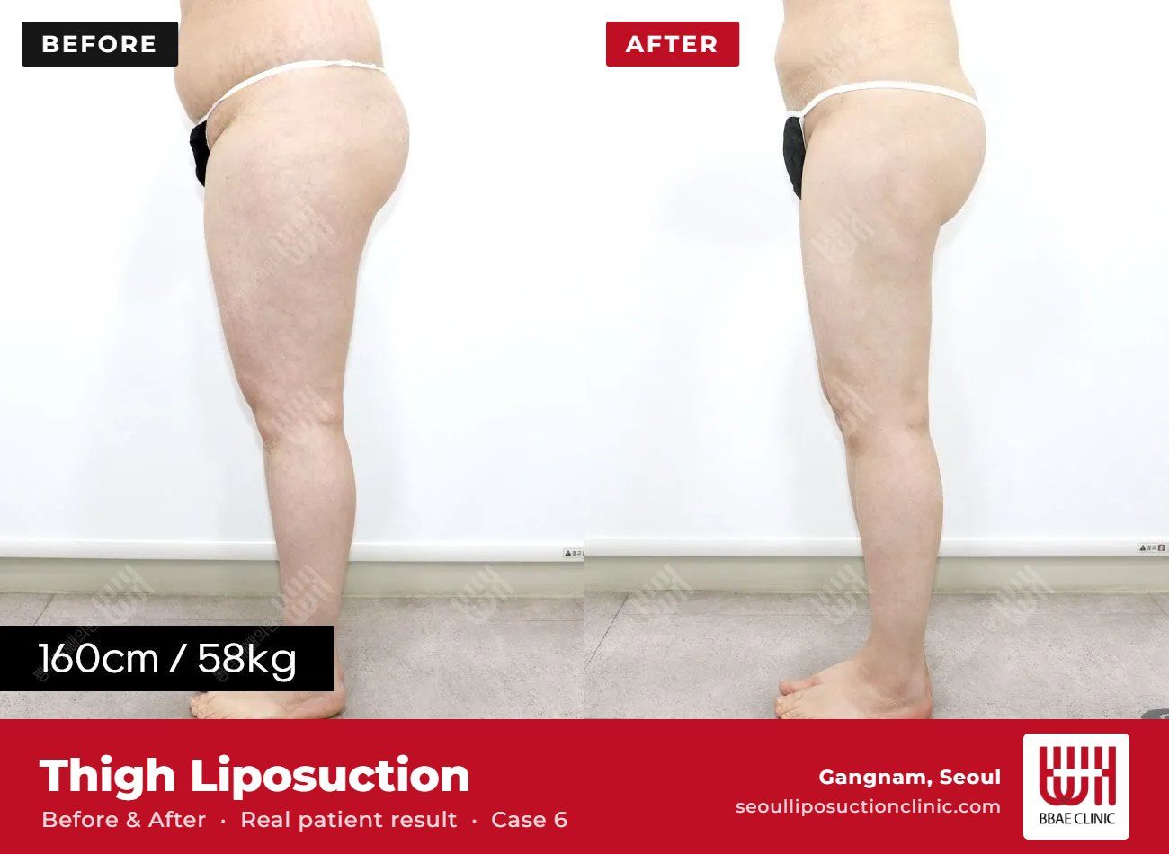 Thigh liposuction before and after, case 6 (photo 2 of 2) – BBAE Clinic, Gangnam Seoul