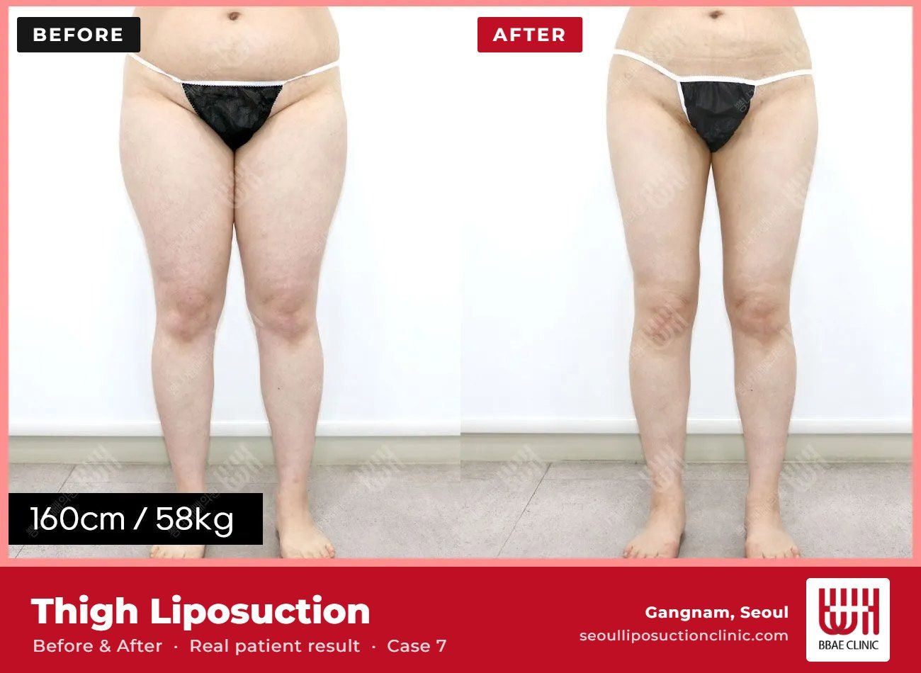 Thigh liposuction before and after, case 7 (photo 1 of 2) – BBAE Clinic, Gangnam Seoul