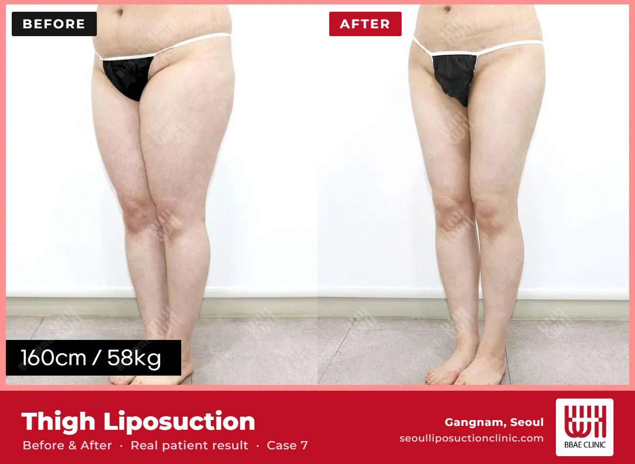 Thigh liposuction before and after, case 7 (photo 2 of 2) – BBAE Clinic, Gangnam Seoul