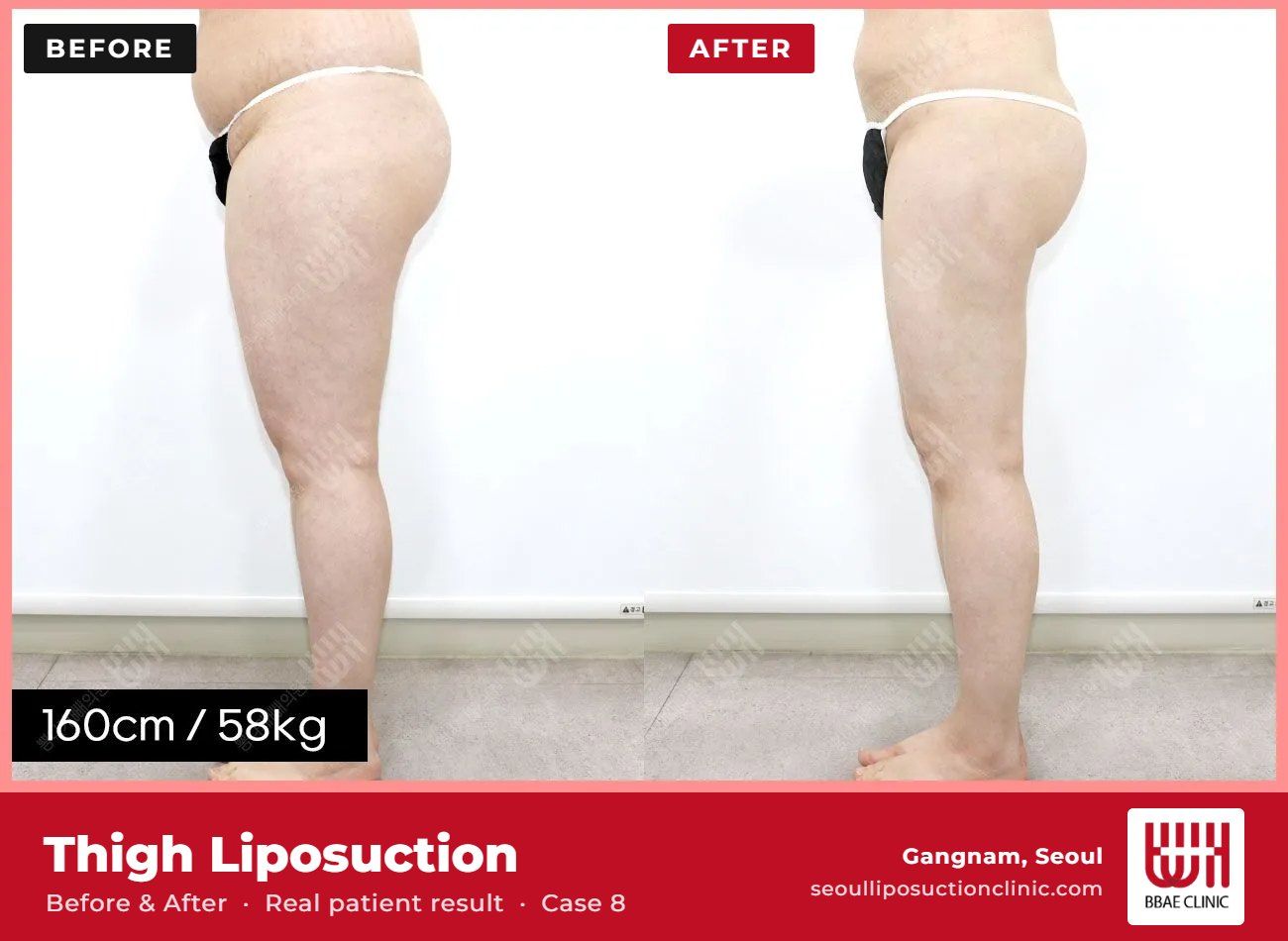 Thigh liposuction before and after, case 8 (photo 1 of 2) – BBAE Clinic, Gangnam Seoul