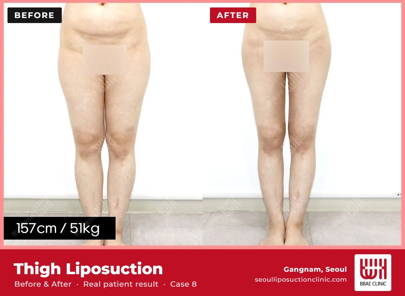 Thigh liposuction before and after, case 8 (photo 2 of 2) – BBAE Clinic, Gangnam Seoul