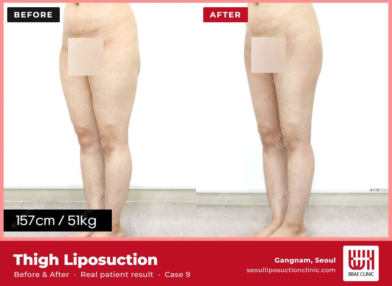 Thigh liposuction before and after, case 9 (photo 1 of 2) – BBAE Clinic, Gangnam Seoul