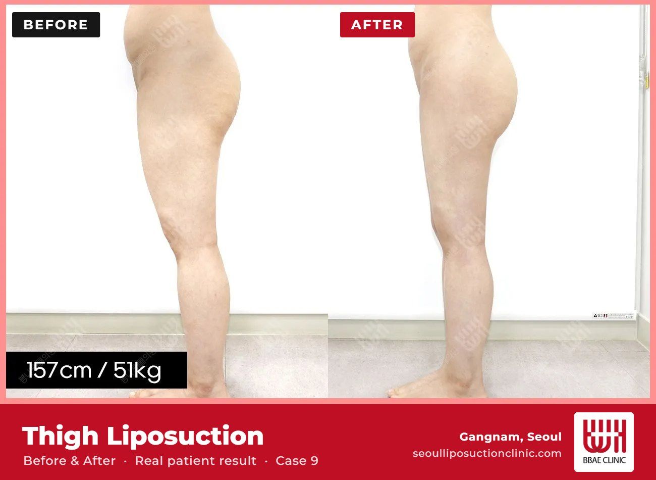Thigh liposuction before and after, case 9 (photo 2 of 2) – BBAE Clinic, Gangnam Seoul