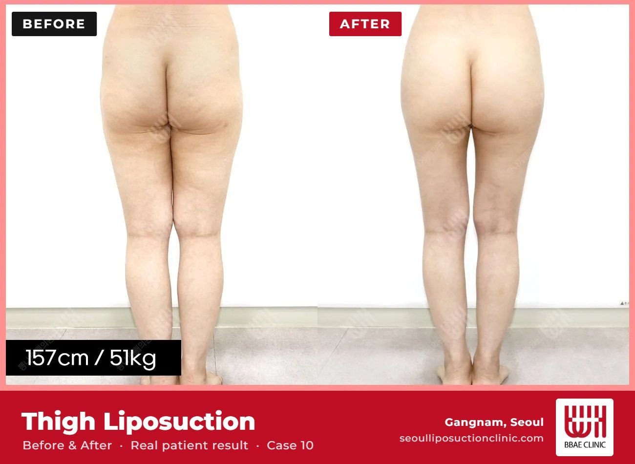 Thigh liposuction before and after, case 10 (photo 1 of 2) – BBAE Clinic, Gangnam Seoul