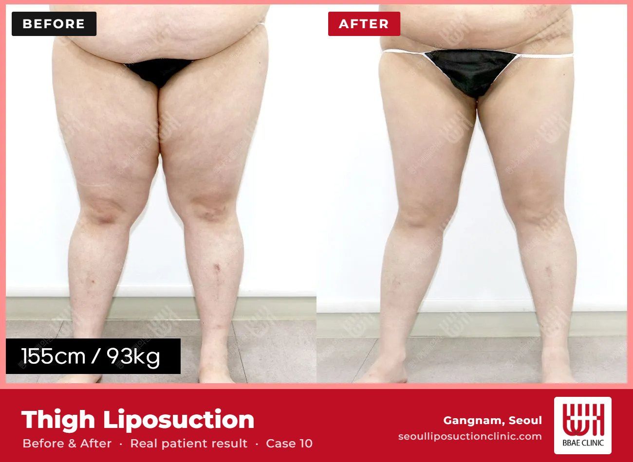 Thigh liposuction before and after, case 10 (photo 2 of 2) – BBAE Clinic, Gangnam Seoul
