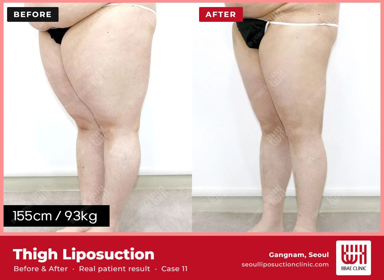 Thigh liposuction before and after, case 11 (photo 1 of 2) – BBAE Clinic, Gangnam Seoul