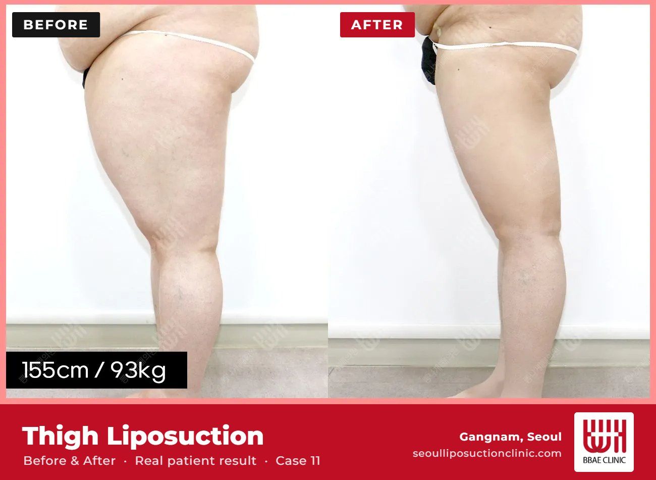 Thigh liposuction before and after, case 11 (photo 2 of 2) – BBAE Clinic, Gangnam Seoul
