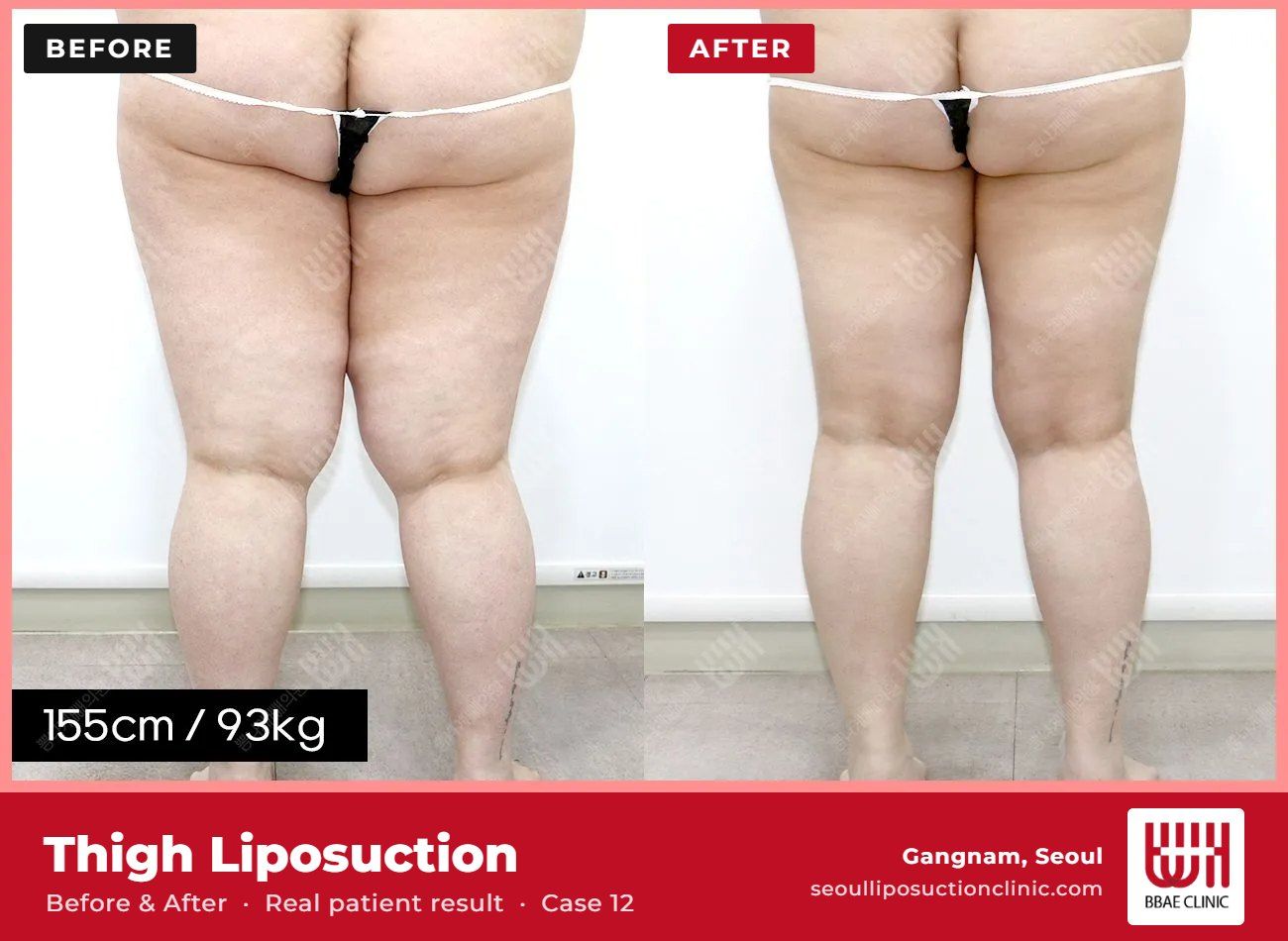 Thigh liposuction before and after, case 12 (photo 1 of 2) – BBAE Clinic, Gangnam Seoul