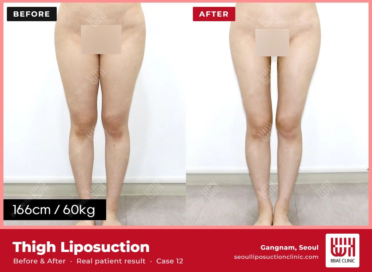 Thigh liposuction before and after, case 12 (photo 2 of 2) – BBAE Clinic, Gangnam Seoul