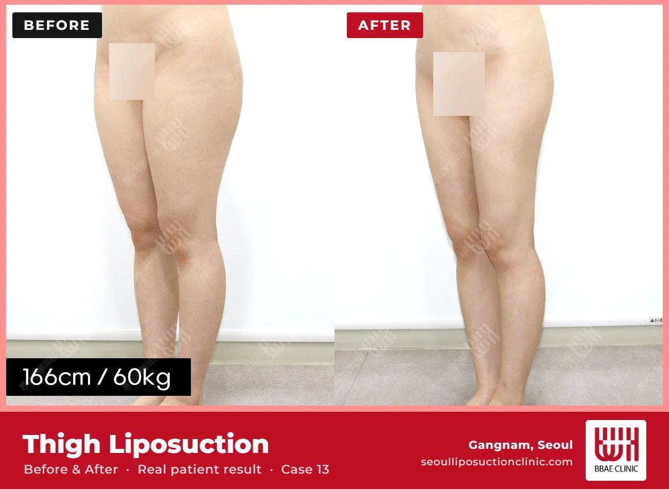 Thigh liposuction before and after, case 13 (photo 1 of 2) – BBAE Clinic, Gangnam Seoul
