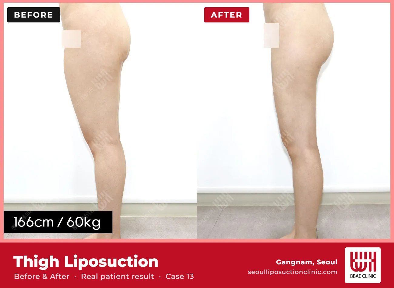 Thigh liposuction before and after, case 13 (photo 2 of 2) – BBAE Clinic, Gangnam Seoul