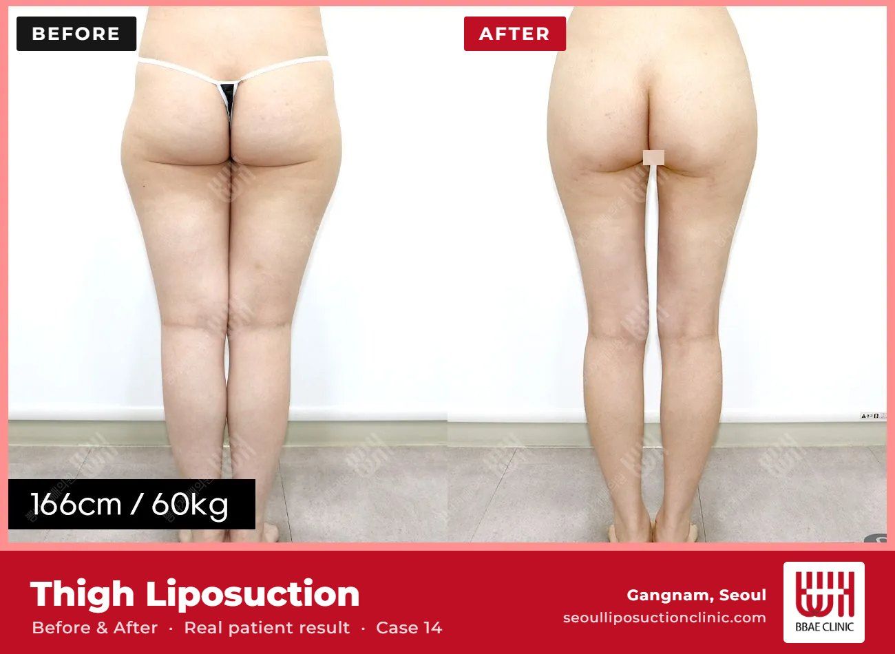 Thigh liposuction before and after, case 14 (photo 1 of 2) – BBAE Clinic, Gangnam Seoul