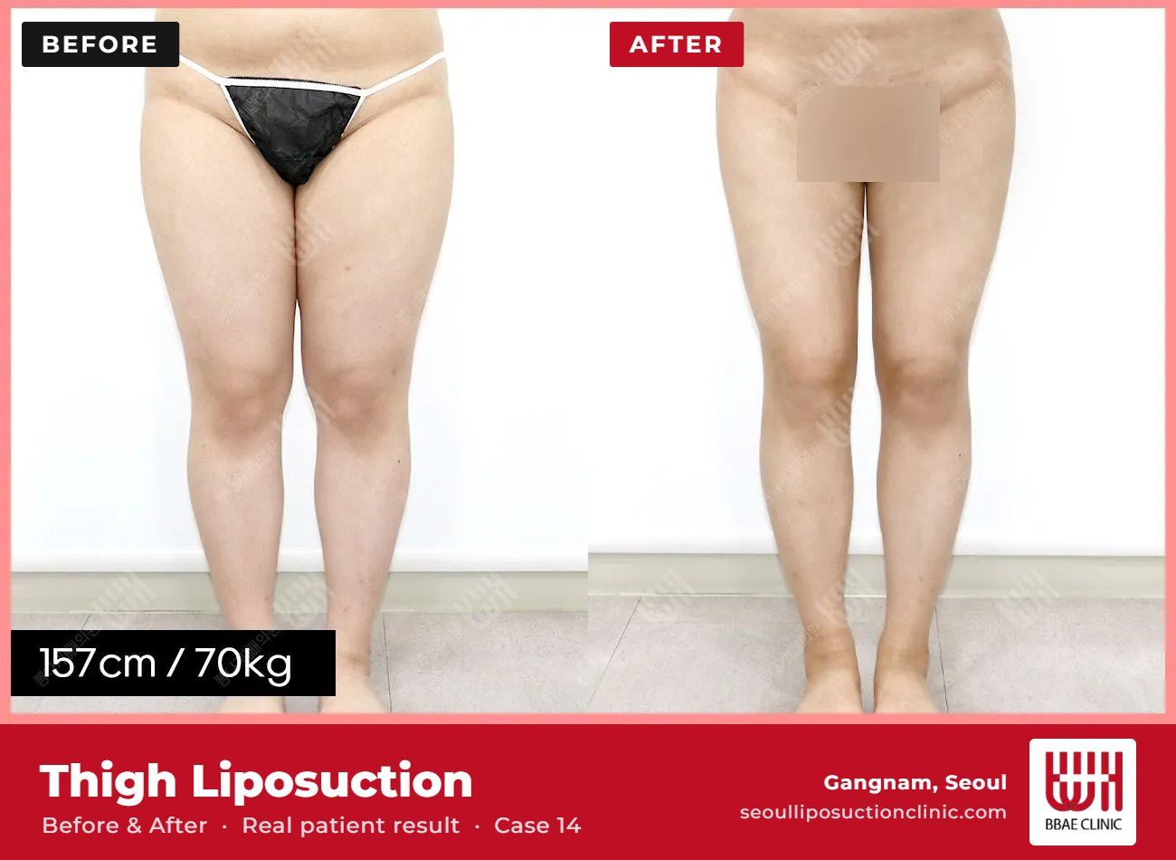 Thigh liposuction before and after, case 14 (photo 2 of 2) – BBAE Clinic, Gangnam Seoul