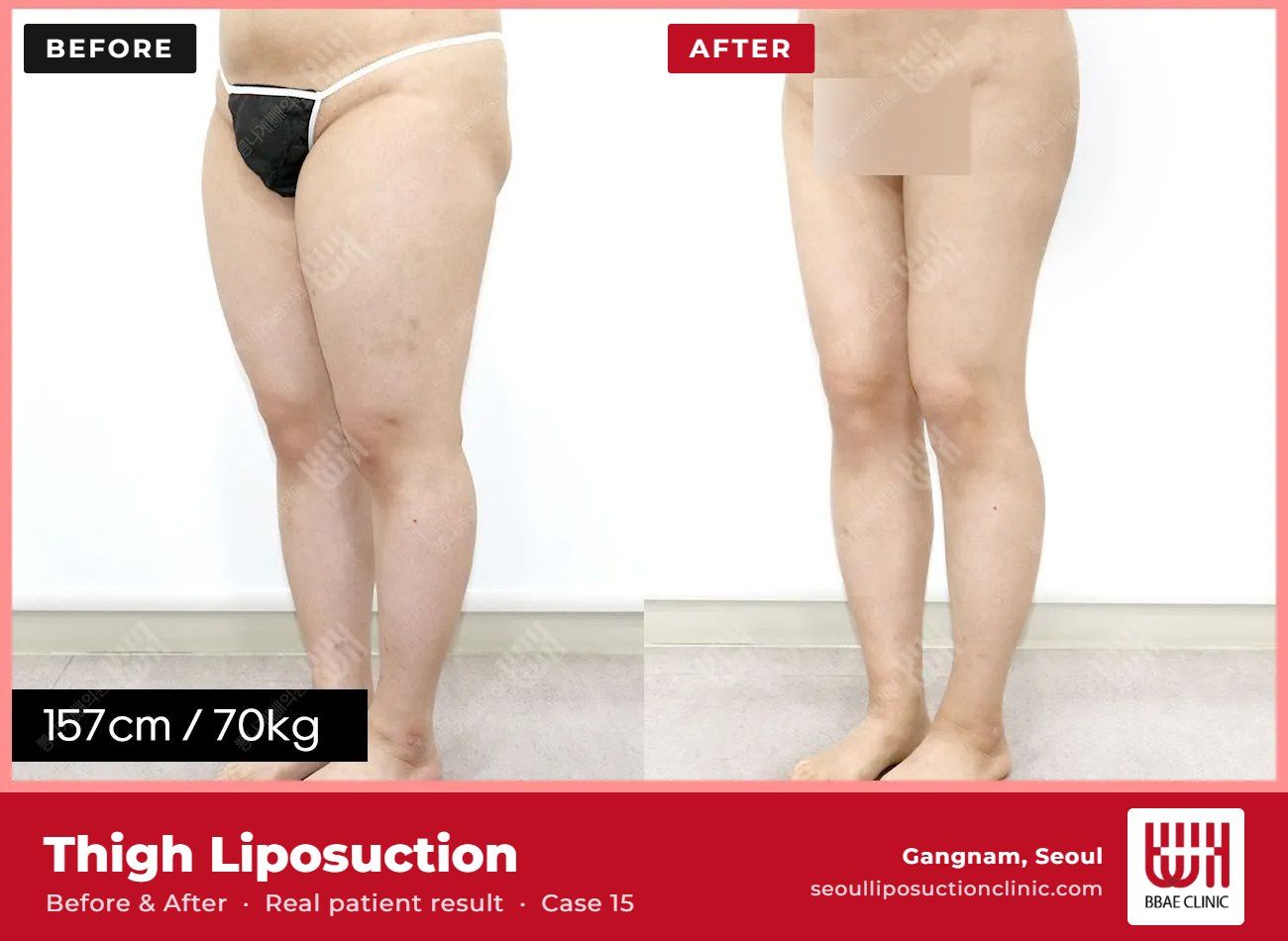 Thigh liposuction before and after, case 15 (photo 1 of 2) – BBAE Clinic, Gangnam Seoul