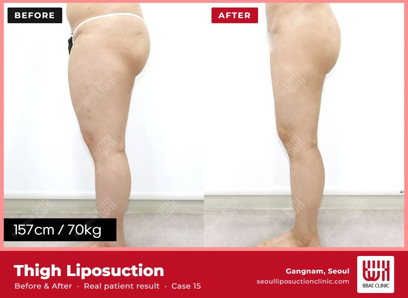 Thigh liposuction before and after, case 15 (photo 2 of 2) – BBAE Clinic, Gangnam Seoul